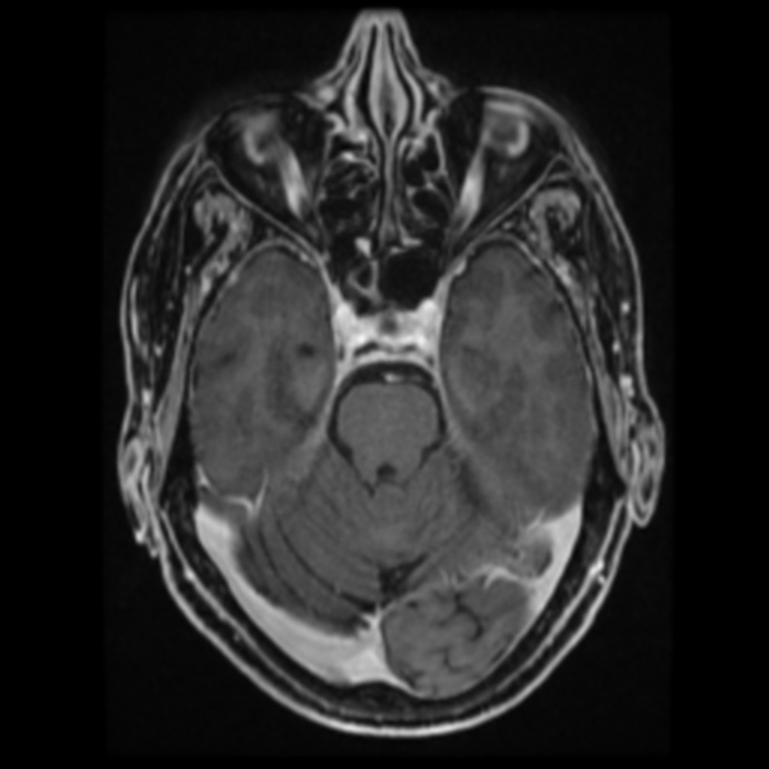 Atypical meningioma (Radiopaedia 45535-49629 Axial T1 C+ 29).jpg