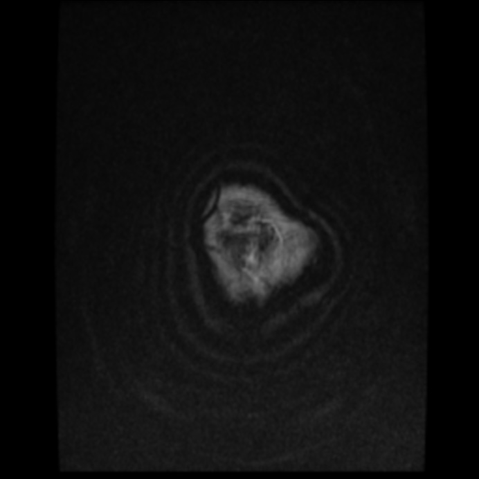 Atypical meningioma (Radiopaedia 45535-49629 Axial T1 C+ 65).jpg