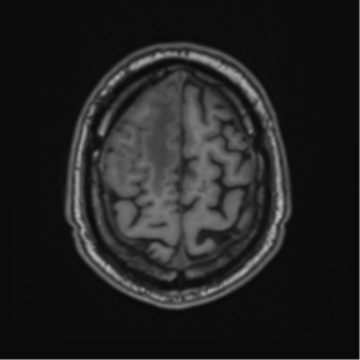 File:Atypical meningioma (WHO grade II) with brain invasion (Radiopaedia 57767-64729 Axial T1 44).png