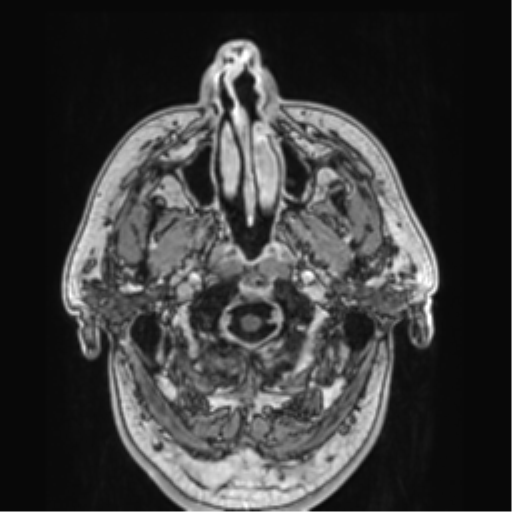 File:Atypical meningioma (WHO grade II) with brain invasion (Radiopaedia 57767-64729 Axial T1 C+ 1).png
