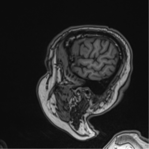 Atypical meningioma (WHO grade II) with brain invasion (Radiopaedia 57767-64729 Sagittal T1 57).png