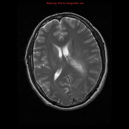 File:Atypical meningioma - grade II (Radiopaedia 13303-13305 Axial T2 13).jpg