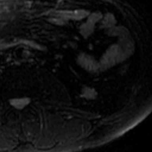File:Atypical renal cyst on MRI (Radiopaedia 17349-17046 Axial T2 fat sat 22).jpg