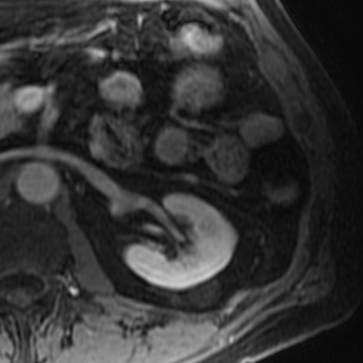 File:Atypical renal cyst on MRI (Radiopaedia 17349-17046 D 16).jpg