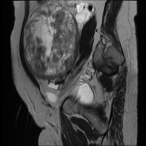 File:Atypical retroperitoneal lymphocoeles with large leiomyoma of uterus (Radiopaedia 32084-33027 Sagittal T2 8).jpg