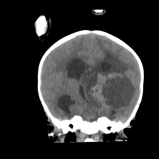 Atypical teratoid rhabdoid tumor (AT-RT) (Radiopaedia 85823-101654 Coronal non-contrast 28).jpg