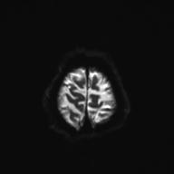 Autoimmune limbic encephalitis (Radiopaedia 30363-31005 Axial B0 and DWI 30).jpg