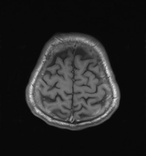 File:Autoimmune limbic encephalitis (Radiopaedia 30363-31005 Axial T1 28).jpg