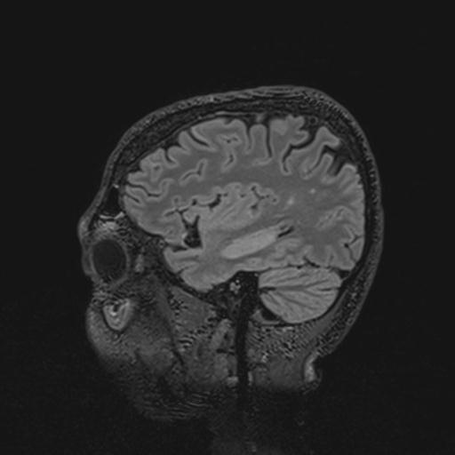 Autoimmune limbic encephalitis (Radiopaedia 30363-31005 Sagittal FLAIR 115).jpg