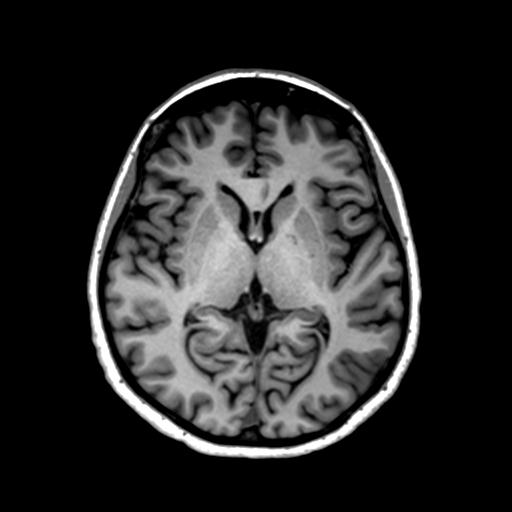 Autoimmune limbic encephalitis (Radiopaedia 30363-31005 T1 Axial 1mm 79).jpg