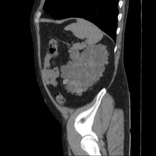 Autosomal dominant polycystic kidney disease (Radiopaedia 36539-38101 D 67).jpg