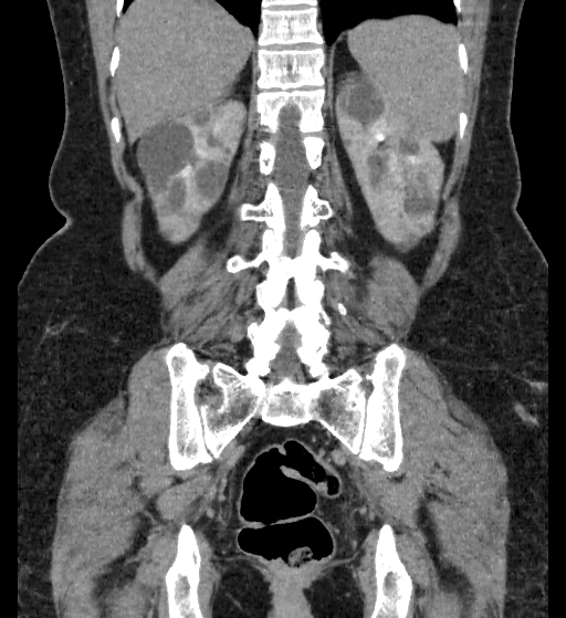 Autosomal dominant polycystic kidney disease (Radiopaedia 38189-40194 Coronal C+ delayed 79).jpg