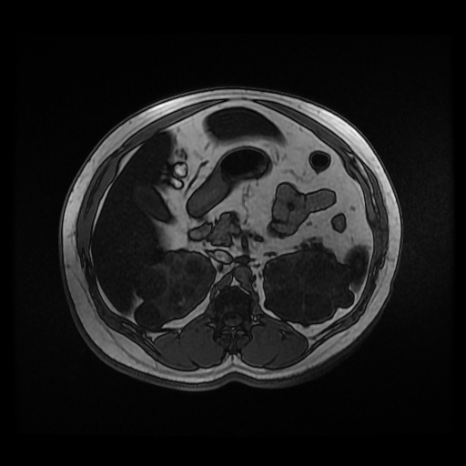 Autosomal dominant polycystic kidney disease (Radiopaedia 50259-55611 Axial 2D Dual Echo 39).jpg