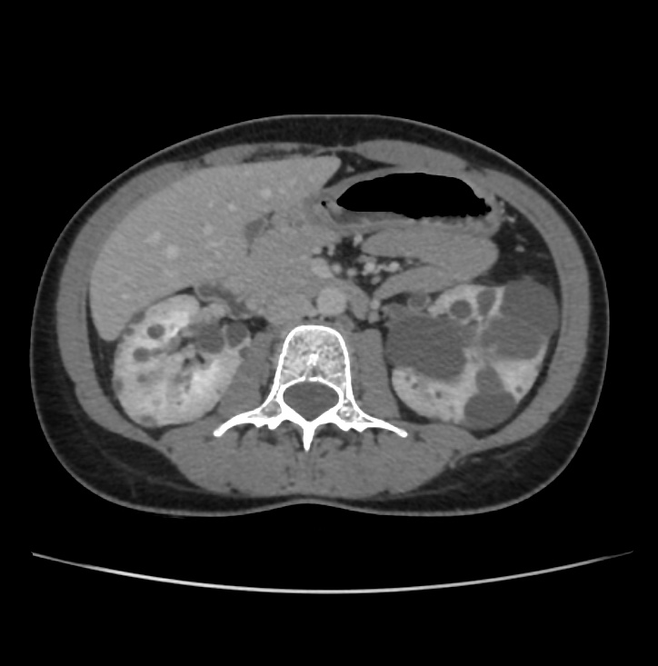 Autosomal dominant polycystic kidney disease - early onset (Radiopaedia 40734-43387 A 33).jpg