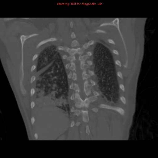 File:Avascular necrosis in sickle cell disease (Radiopaedia 17448-17152 Coronal bone window 104).jpg