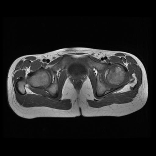 File:Avascular necrosis of the hip (Radiopaedia 29563-30067 Axial T1 10).jpg