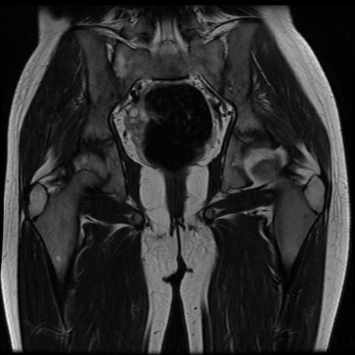 File:Avascular necrosis of the hip (Radiopaedia 29563-30067 Coronal T2 11).jpg