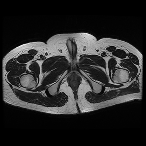 File:Avascular necrosis of the hip (Radiopaedia 61503-69465 T2 25).jpg