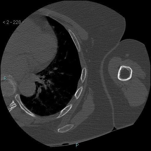 File:Avascular necrosis of the shoulder - Cruess stage I (Radiopaedia 77674-89887 Axial bone window 57).jpg