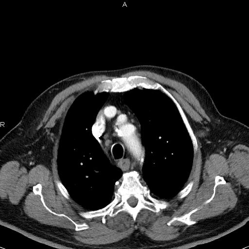 File:Azygos continuation of the inferior vena cava (Radiopaedia 18537-18404 C+ arterial phase 15).jpg