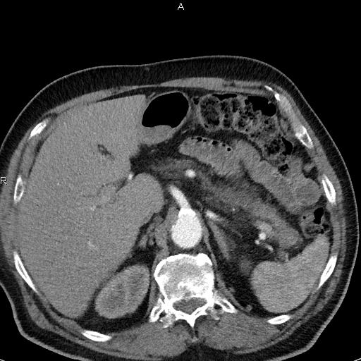File:Azygos continuation of the inferior vena cava (Radiopaedia 18537-18404 C+ arterial phase 57).jpg