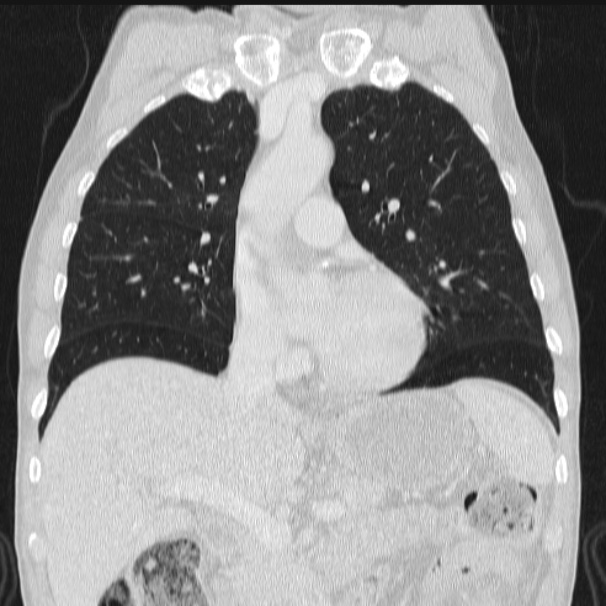 Azygos lobe (Radiopaedia 38259-40275 Coronal lung window 33).jpg