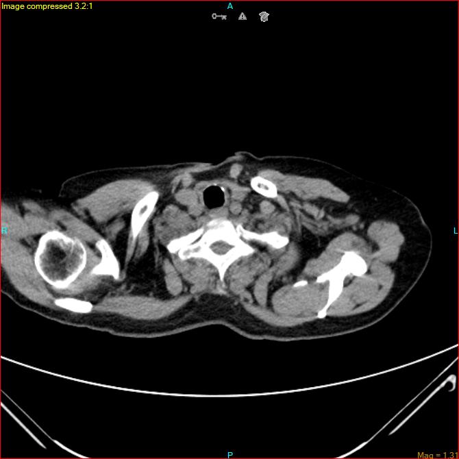 Azygos vein aneurysm (Radiopaedia 77824-90130 A 6).jpg