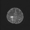 Balo concentric sclerosis (Radiopaedia 50458-55940 Axial DWI 29).jpg