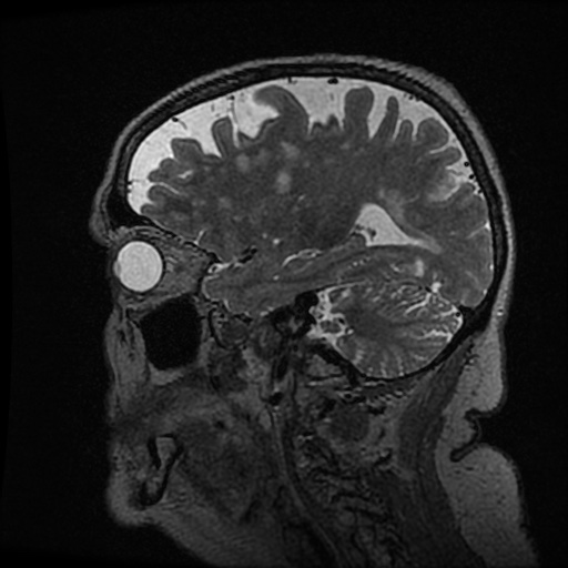 Balo concentric sclerosis (Radiopaedia 53875-59982 Sagittal 3D FSE 195).jpg