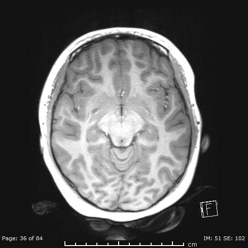 File:Balo concentric sclerosis (Radiopaedia 61637-69636 Axial T1 36).jpg