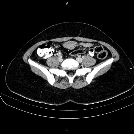 File:Bartholin gland cyst (Radiopaedia 62635-70930 Axial Post contrast 12).jpg