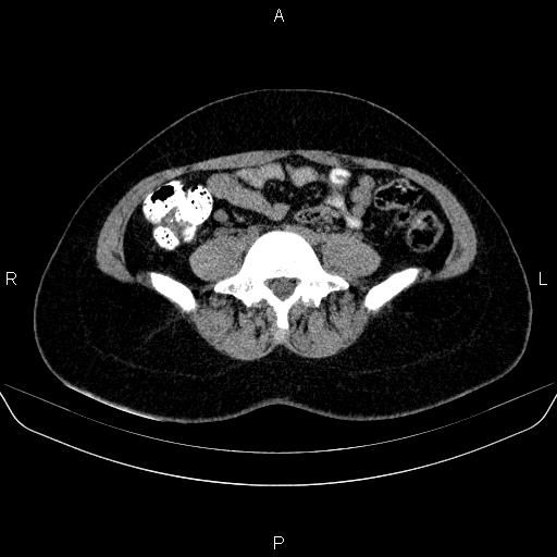 Bartholin gland cyst (Radiopaedia 62635-70930 Axial non-contrast 3).jpg