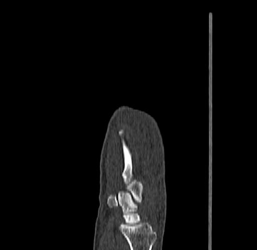 Base of 2nd metacarpal fracture (Radiopaedia 73741-84544 Sagittal bone window 31).jpg