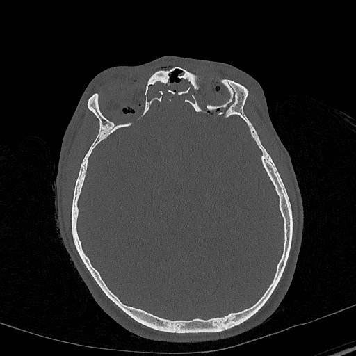 Base of skull fracture with bilateral Le Fort fractures (Radiopaedia 47094-51638 Axial bone window 50).jpg