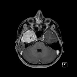 Base of skull rhabdomyosarcoma (Radiopaedia 32196-33142 T1 C+ fat sat 32).jpg