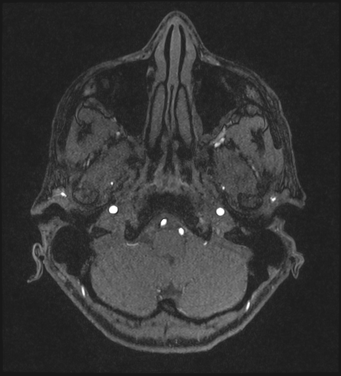 Basilar artery perforator aneurysm (Radiopaedia 82455-97733 Axial MRA 37).jpg