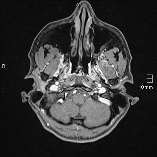Basilar artery perforator aneurysm (Radiopaedia 82455-99523 G 3).jpg