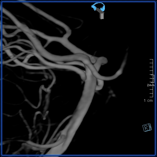 Basilar artery perforator aneurysm (Radiopaedia 82455-99524 3D Left VA 61).jpg