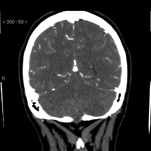 File:Basilar artery thrombosis (Radiopaedia 16260-15944 B 49).jpg