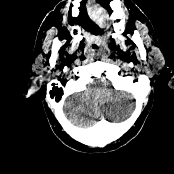 Basilar artery thrombosis (Radiopaedia 53351-59352 Axial non-contrast 21).jpg