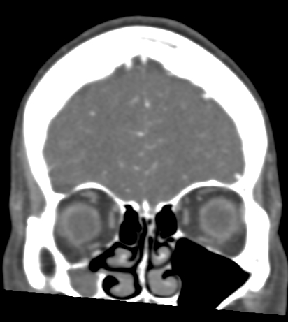 Basilar tip aneurysm with coiling (Radiopaedia 53912-60086 B 23).jpg