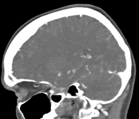 Basilar tip aneurysm with coiling (Radiopaedia 53912-60086 C 43).jpg