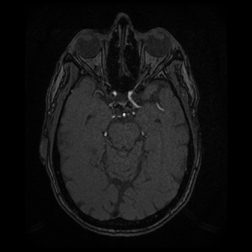 Basilar top and left middle cerebral artery aneurysm (Radiopaedia 61965-70031 Axial MRA 58).jpg