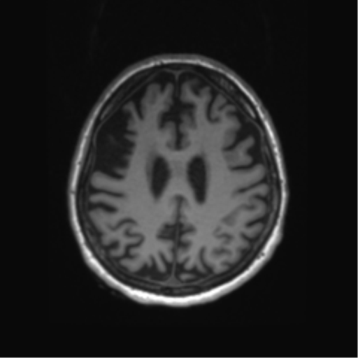 Behavioral variant frontotemporal dementia and late onset schizophrenia (Radiopaedia 52197-58083 Axial T1 26).png