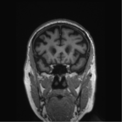 Behavioral variant frontotemporal dementia and late onset schizophrenia (Radiopaedia 52197-58083 Coronal T1 65).png