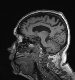 Behavioral variant frontotemporal dementia and late onset schizophrenia (Radiopaedia 52197-58083 Sagittal T1 60).png