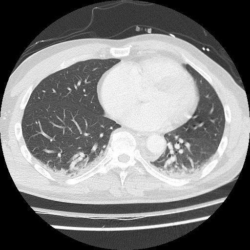 Benign post-traumatic pseudopneumoperitoneum (Radiopaedia 71199-81495 Axial lung window 47).jpg