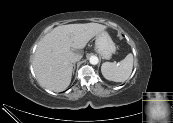 Bicameral celiacomesenteric aneurysm (Radiopaedia 55766-62327 A 11).jpg