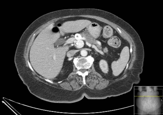 Bicameral celiacomesenteric aneurysm (Radiopaedia 55766-62327 A 20).jpg