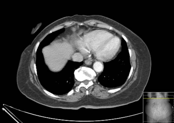 Bicameral celiacomesenteric aneurysm (Radiopaedia 55766-62327 A 3).jpg